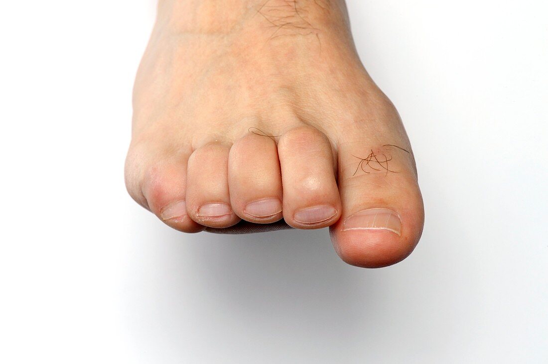 Claw foot in Charcot-Marie-Tooth disease