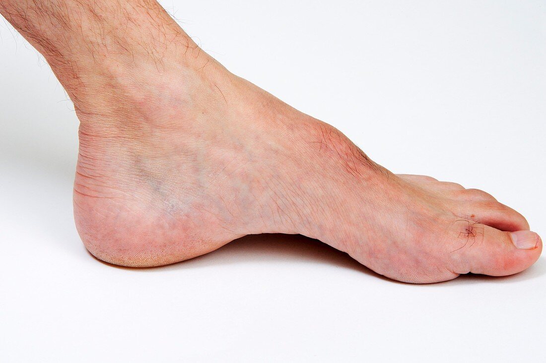Arched foot in Charcot-Marie disease