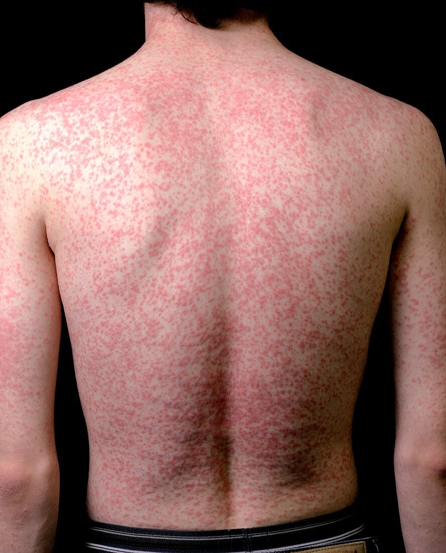 Body rash caused by antibiotic drug