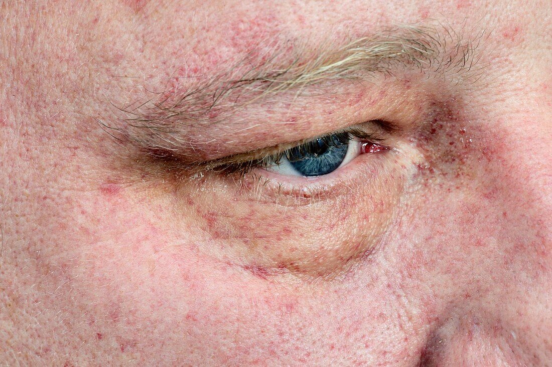 Purpura rash around the eye