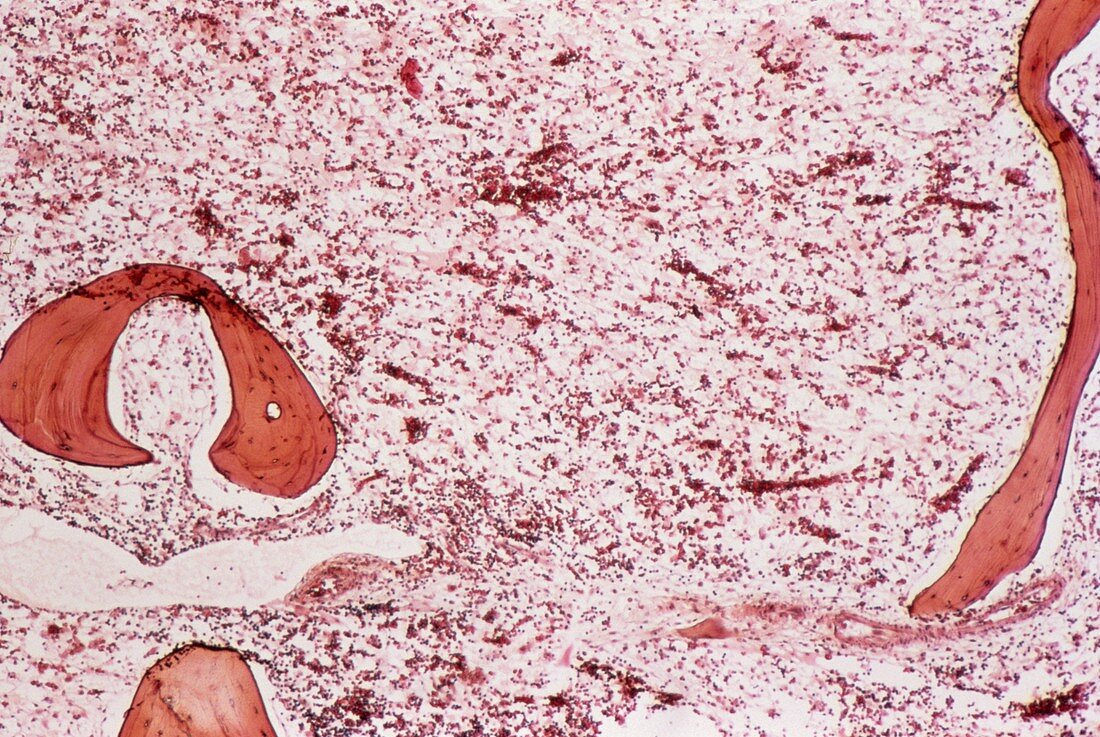 Chronic myeloid leukaemia,micrograph