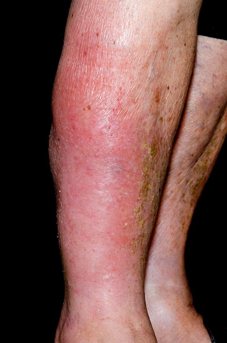 Cellulitis on the leg