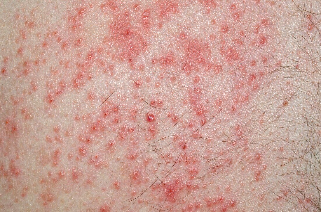 Allergic dermatitis from body armour