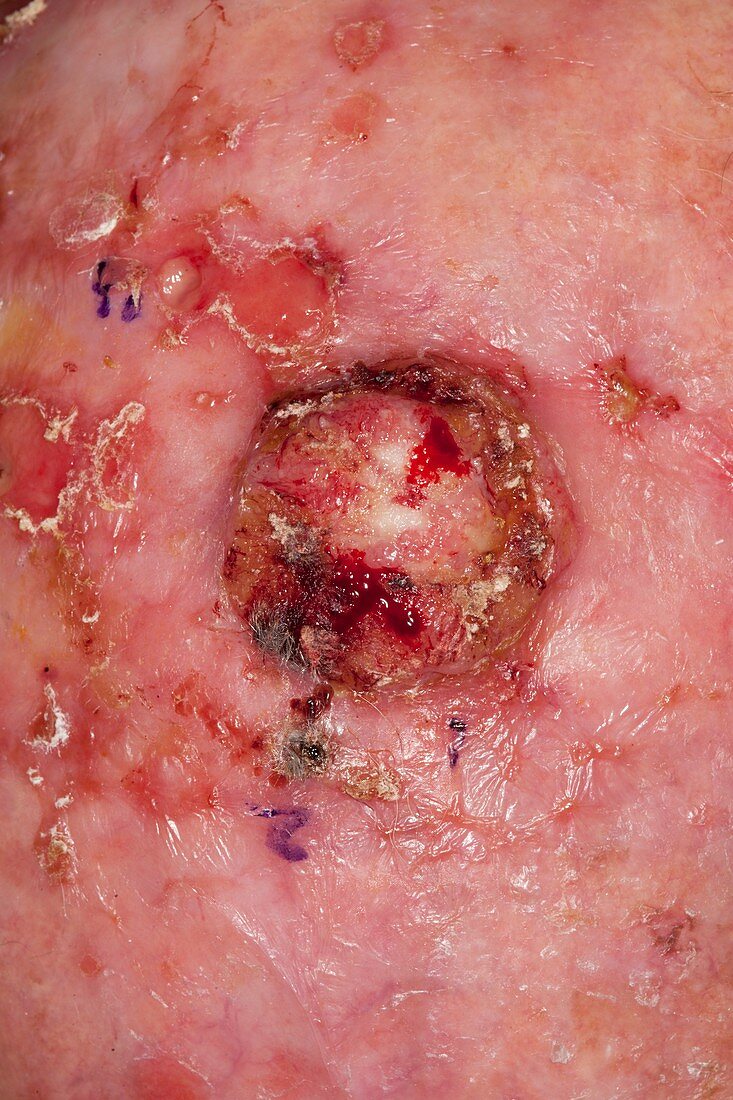 Squamous skin cancer on the scalp