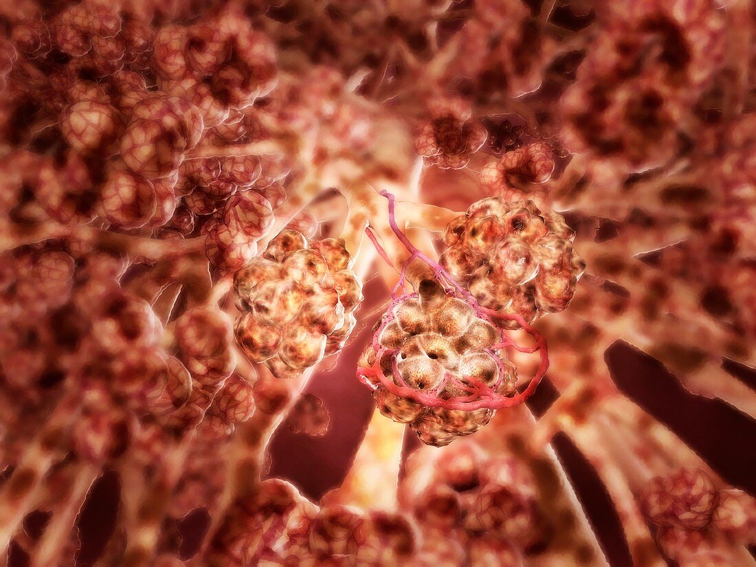 Diseased alveoli in the lung