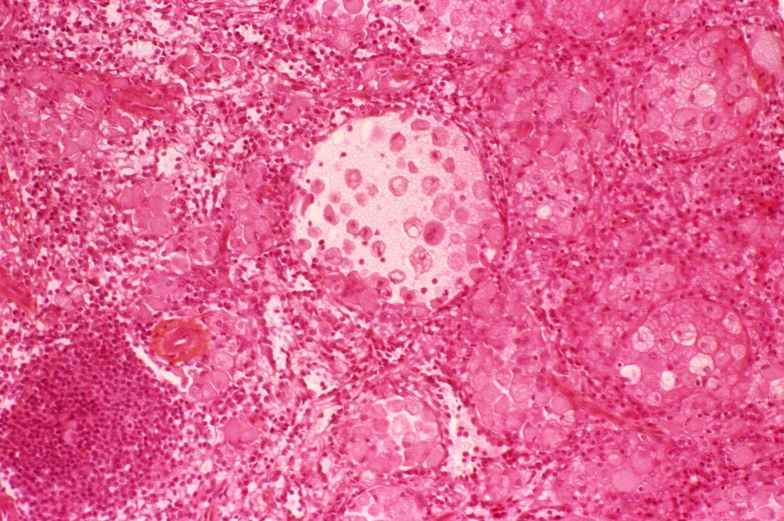 Gaucher's disease,light micrograph
