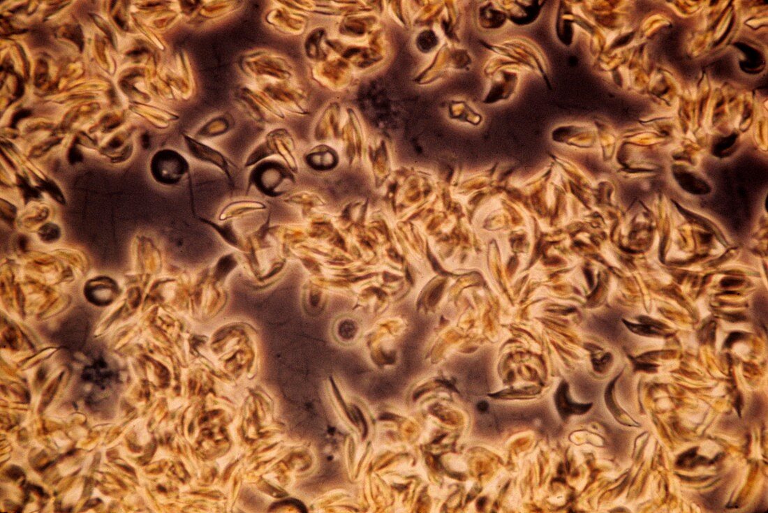 Sickle cell anaemia,light micrograph