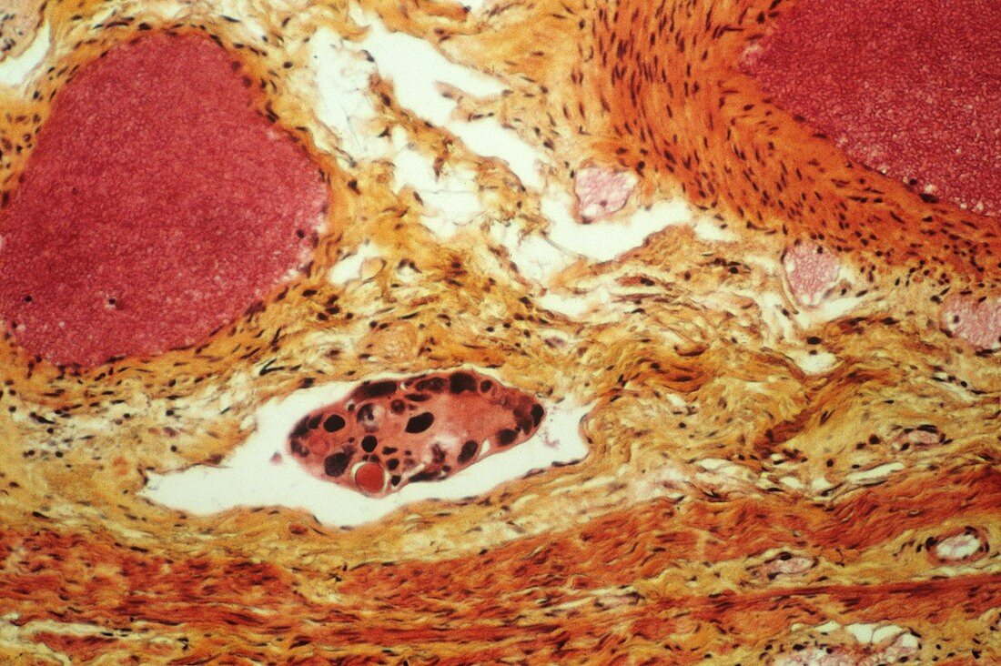 Tumour embolism,light micrograph