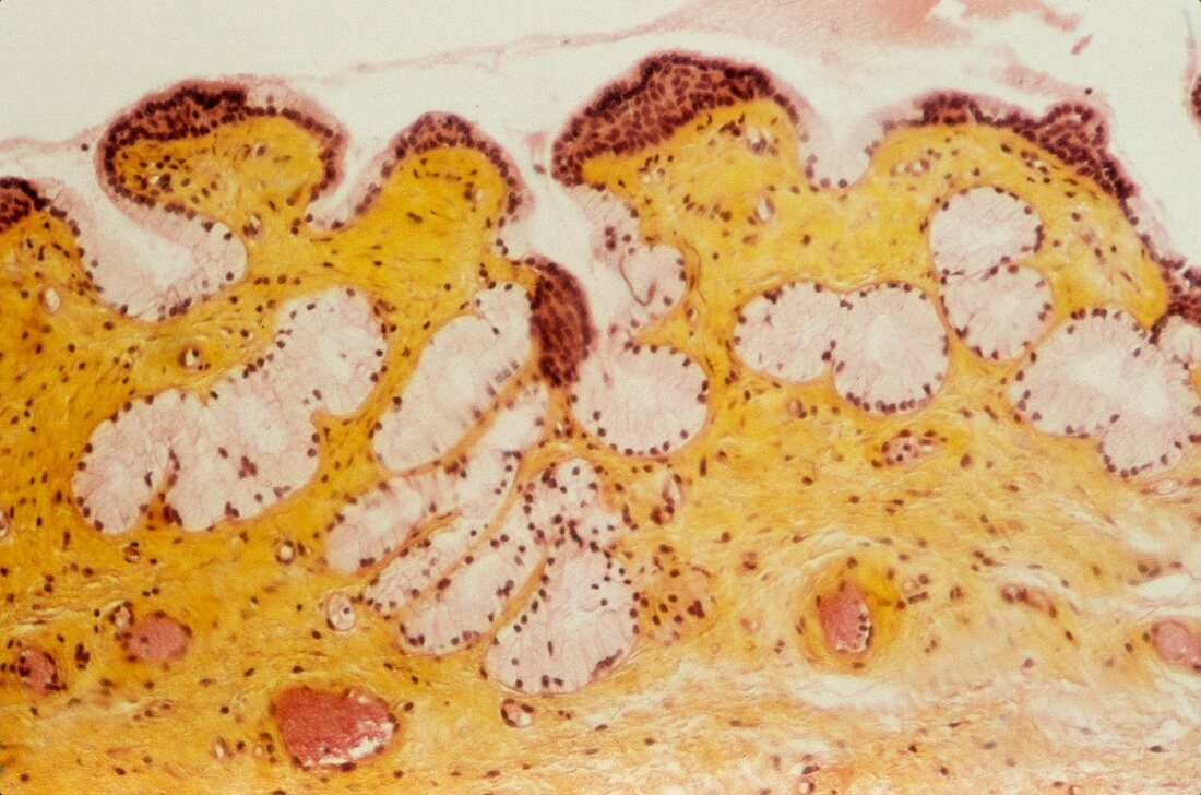 Bartholin's cyst,light micrograph