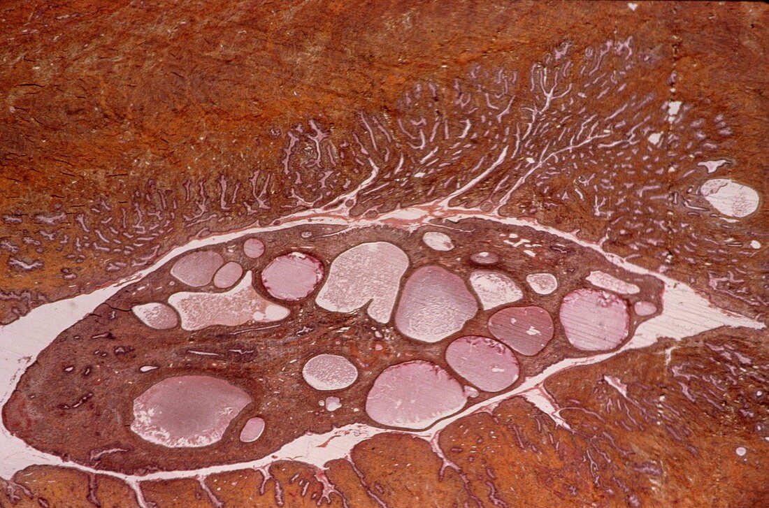 Cervical polyp,light micrograph