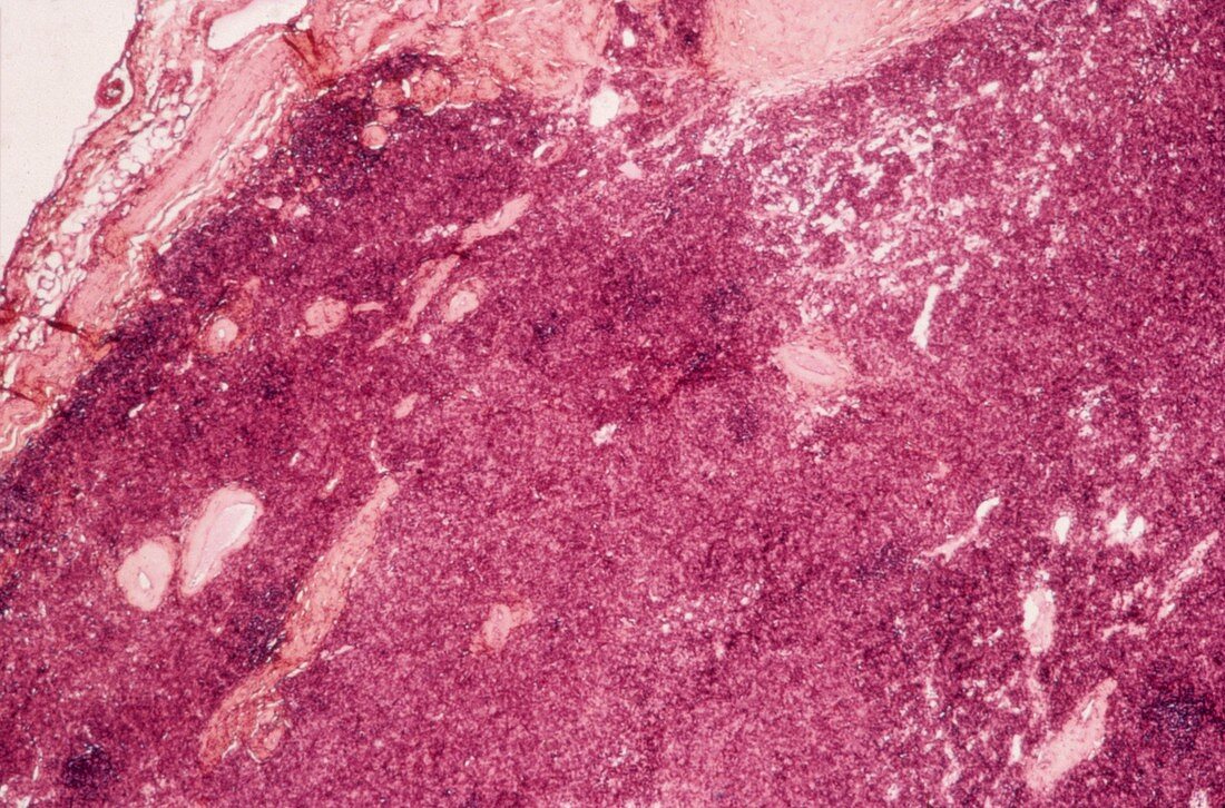 Thymus gland cancer,light micrograph