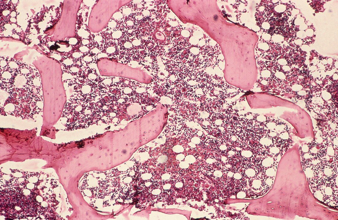 Niemann-Pick disease,light micrograph