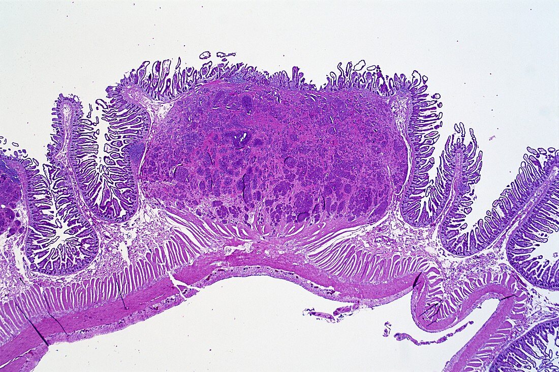 Bowel cancer,light micrograph