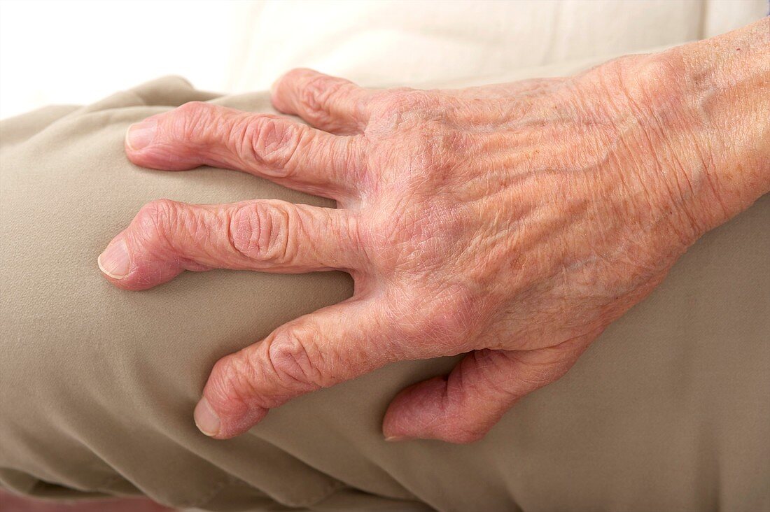 Arthritic hand