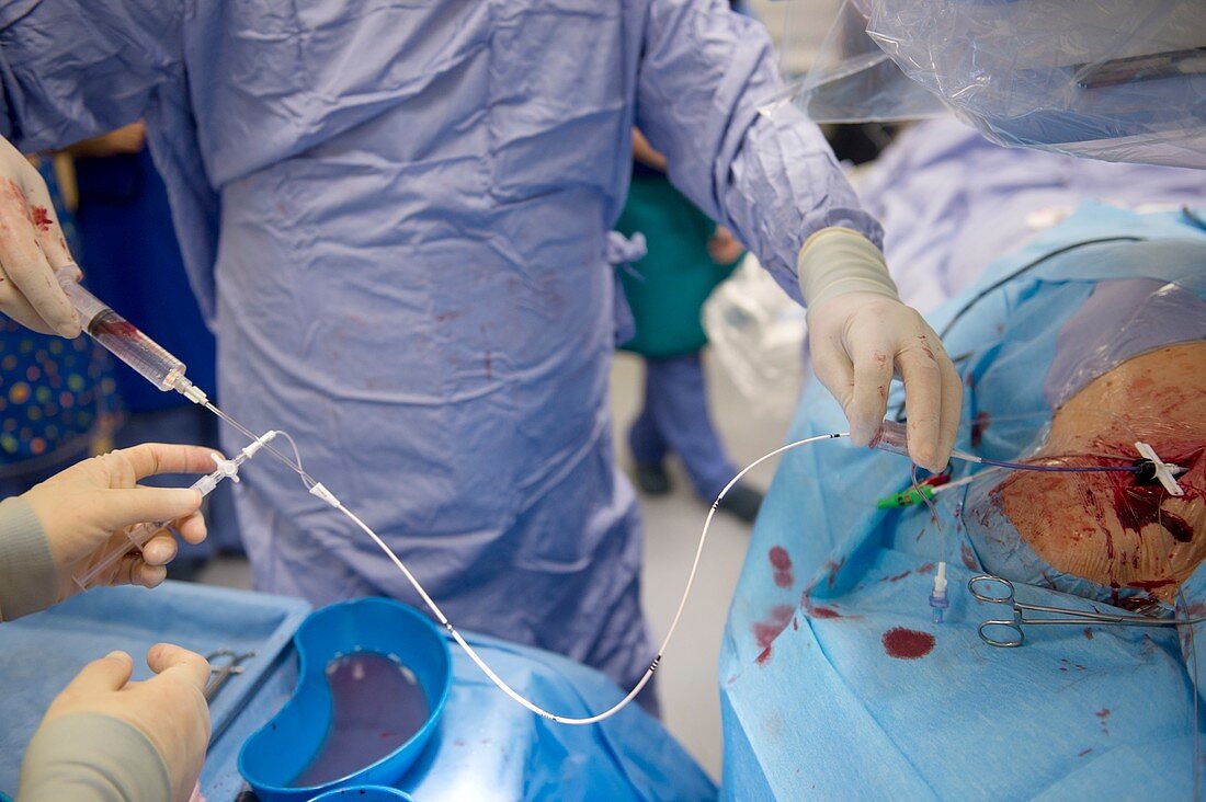 Implantable defibrillator surgery