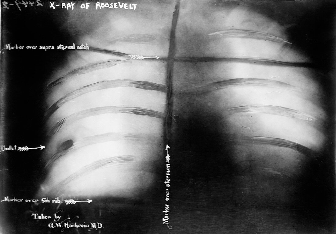 Roosevelt bullet,1912 chest X-ray