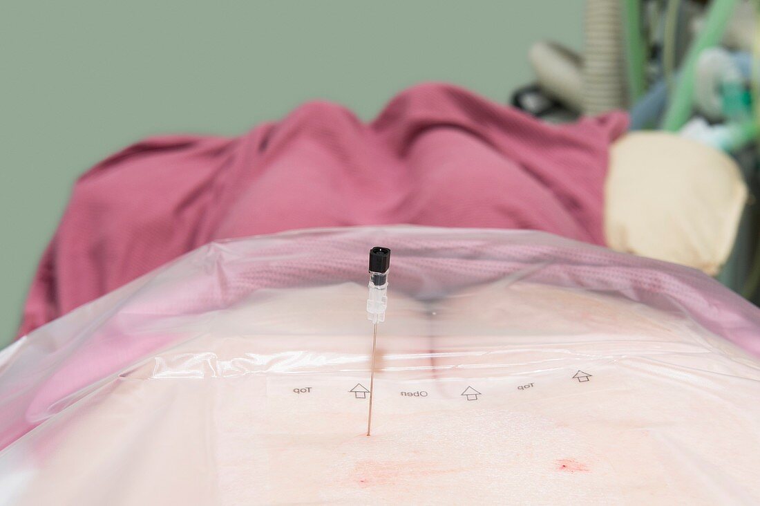 Lumbar anaesthetic injections