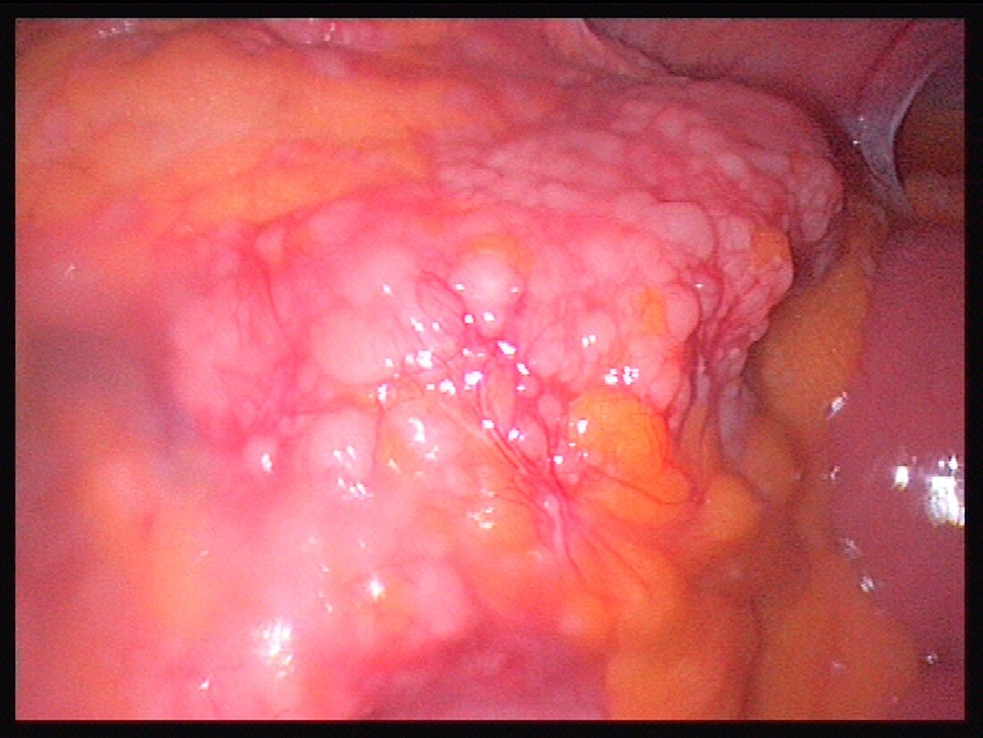 Ovarian cancer,laparascopic image