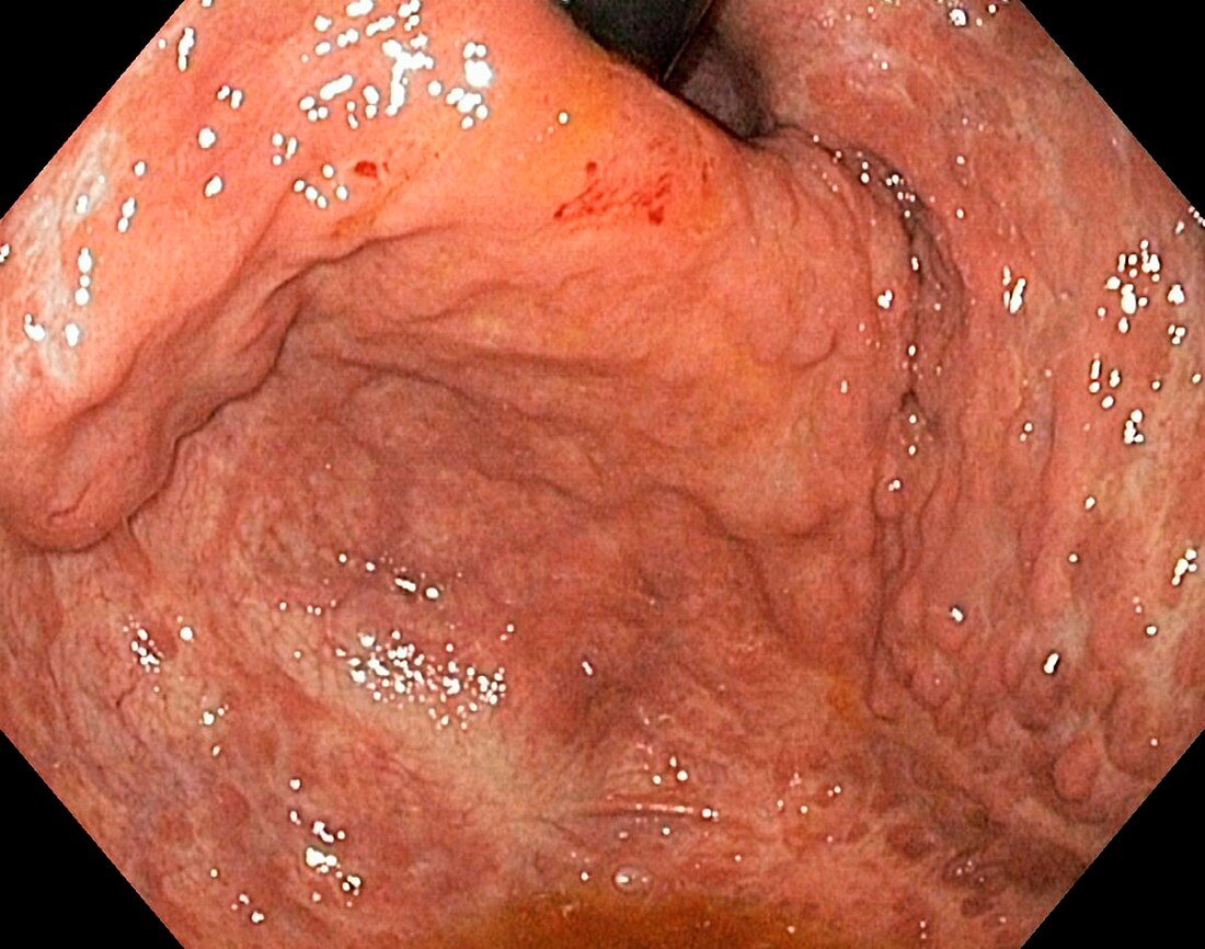 Severe gastritis,endoscope view