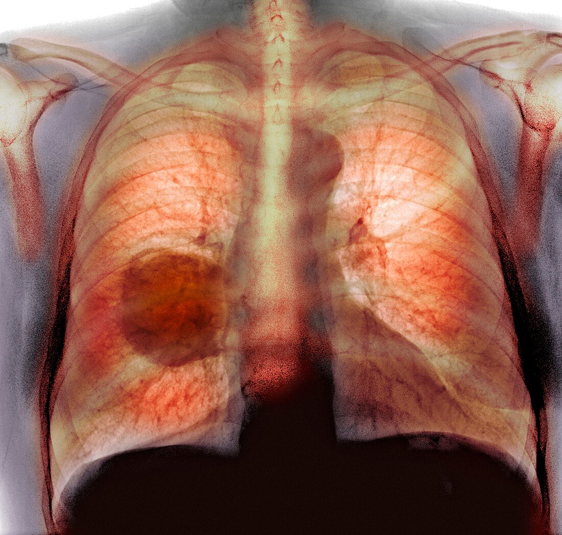 Lung cancer,X-ray