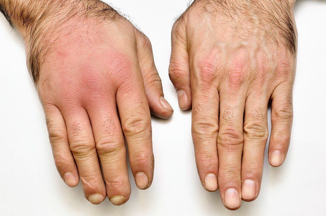 Cellulitis of the hand