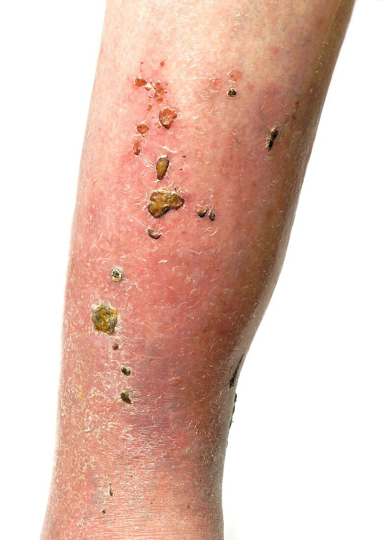 Cellulitis and infected scabs
