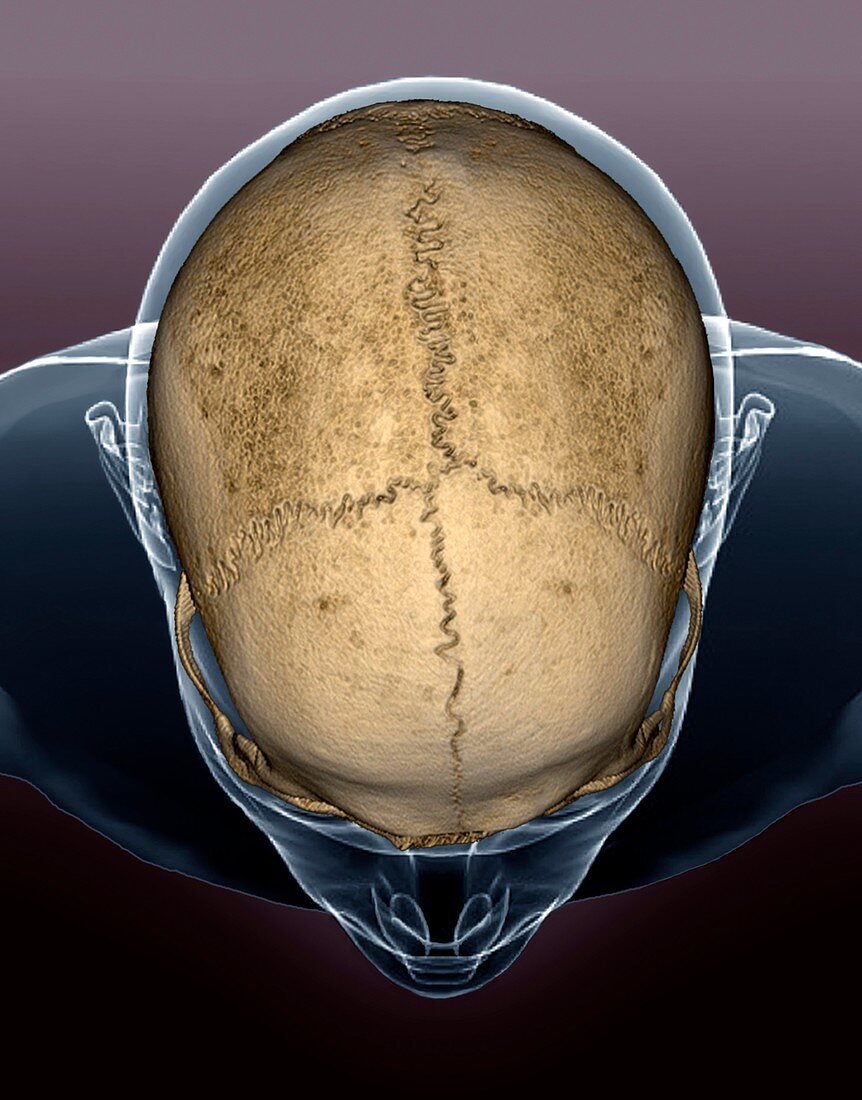 Skull sutures,3D CT scan