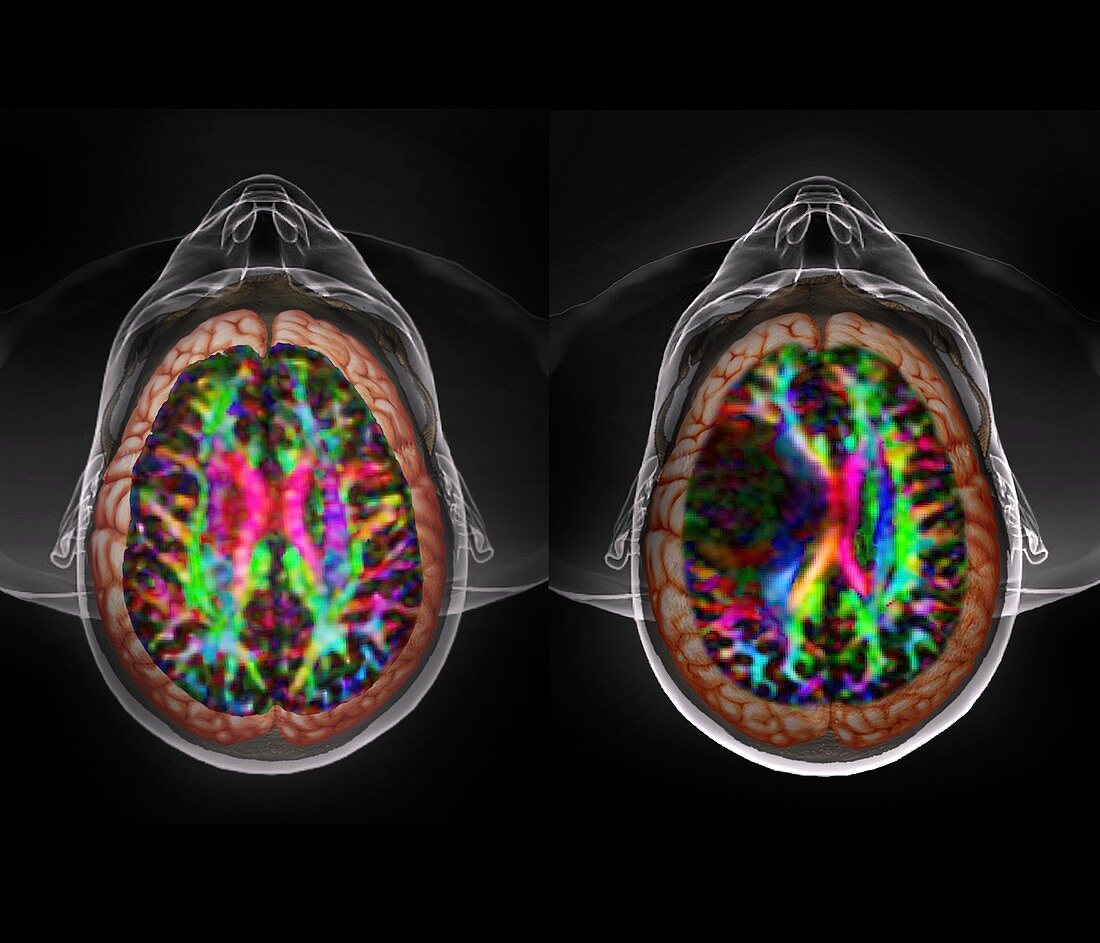 Brain cancer,DTI and 3D CT scans