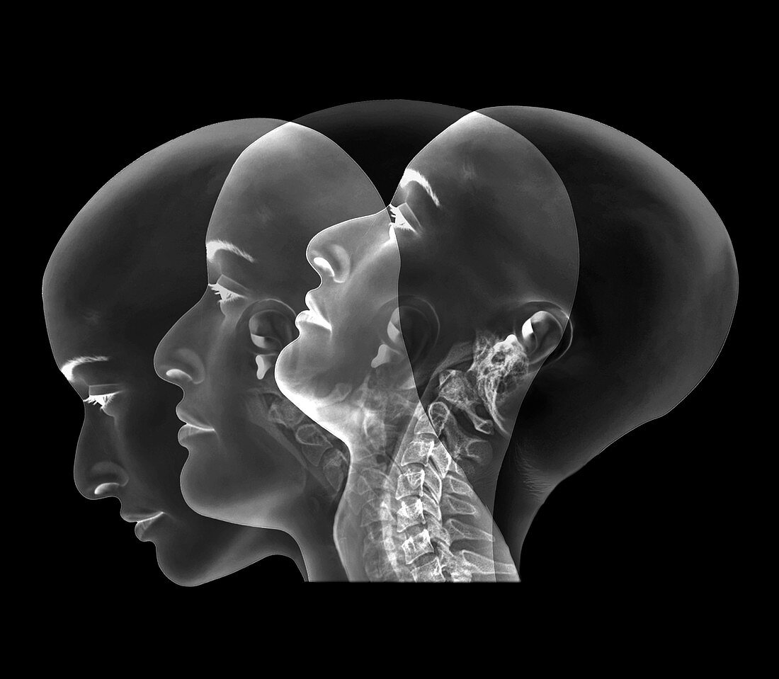 Normal neck,X-rays
