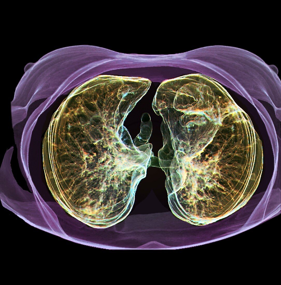 Healthy lungs,3D CT scan