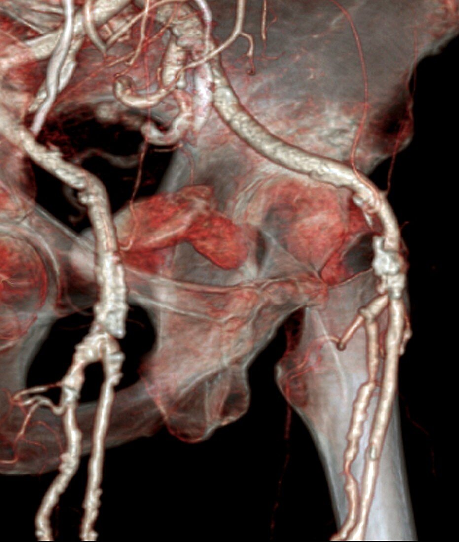 Atherosclerosis,3D CT scan