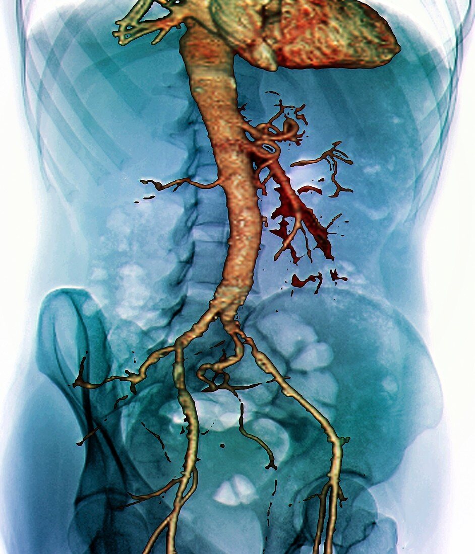 Abdominal aorta,3D CT scan