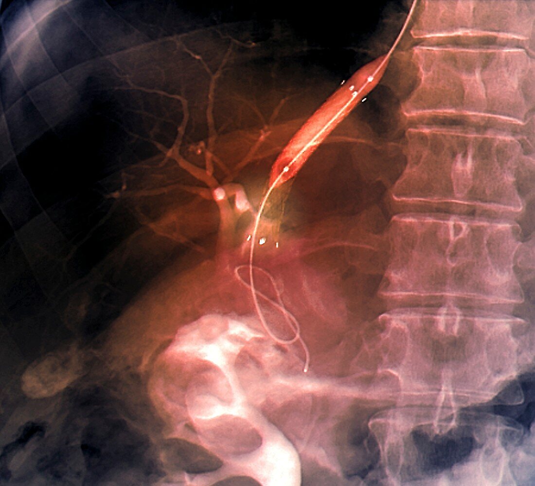 Portal vein surgery,X-ray