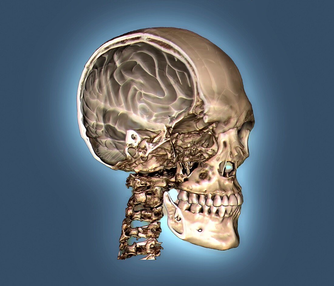 Normal skull and brain,3D CT scan