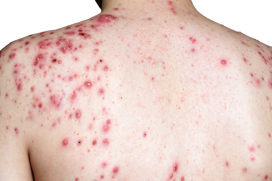 Acne vulgaris on the back
