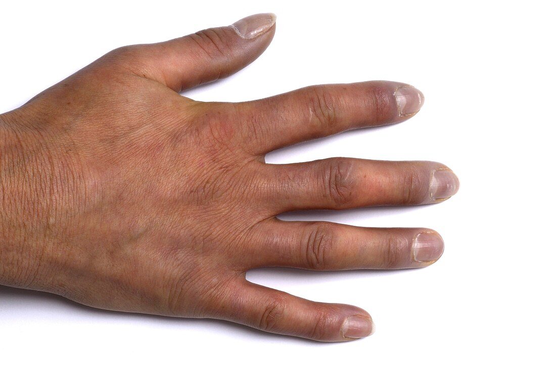 Scleroderma of the fingers