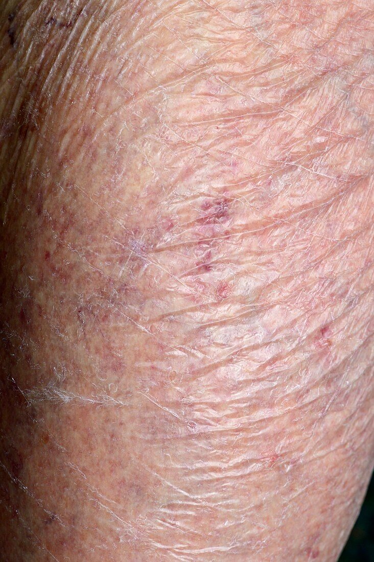 Thinning of the skin from steroids