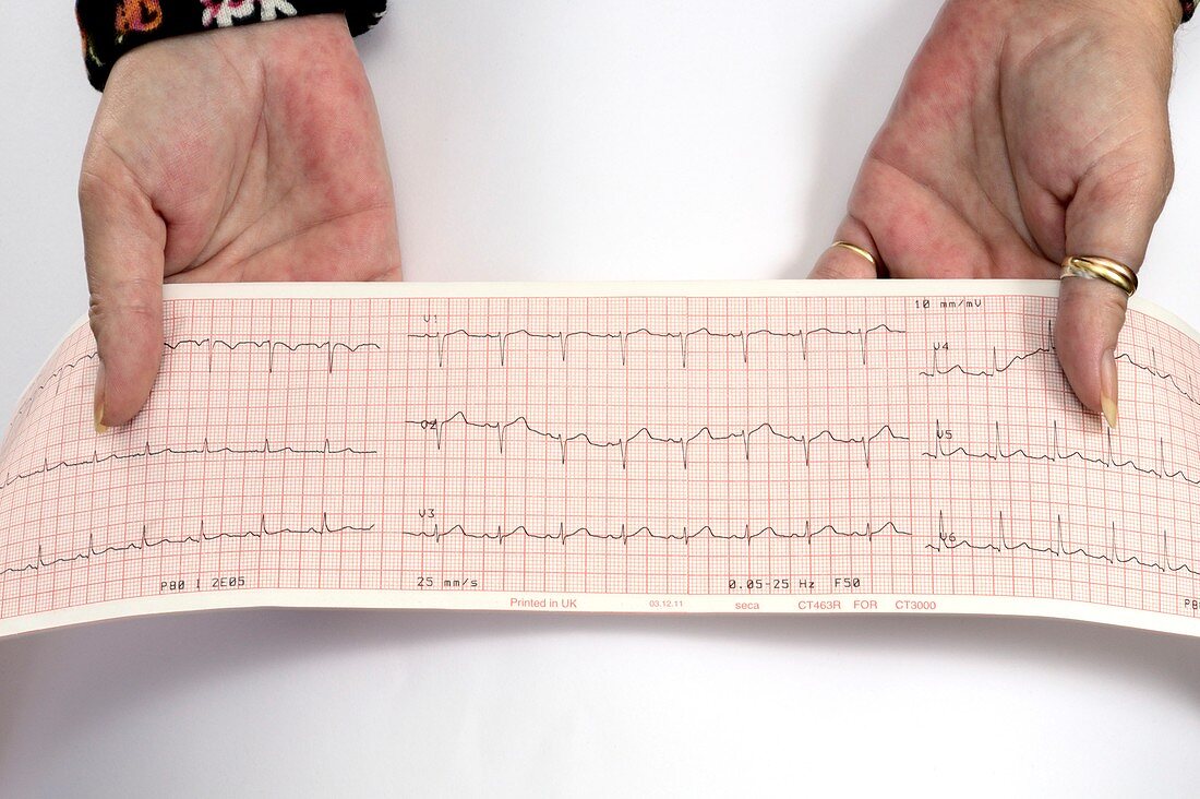 Palmar erythema and abnormal ECG