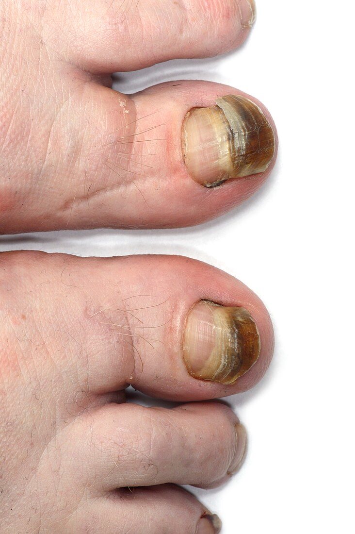 Discoloured toenails from chemotherapy