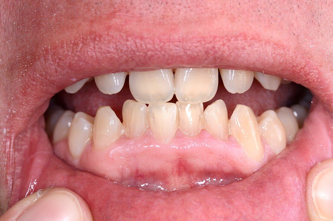 Gum hyperplasia from cyclosporin drug