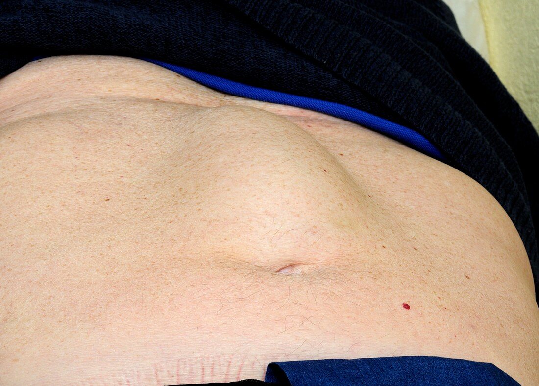 Abnormal abdominal rectus muscles