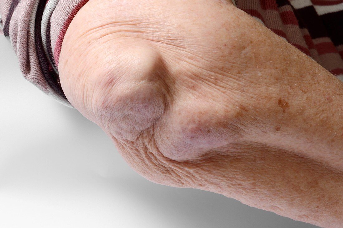 Rheumatoid arthritis in the elbow