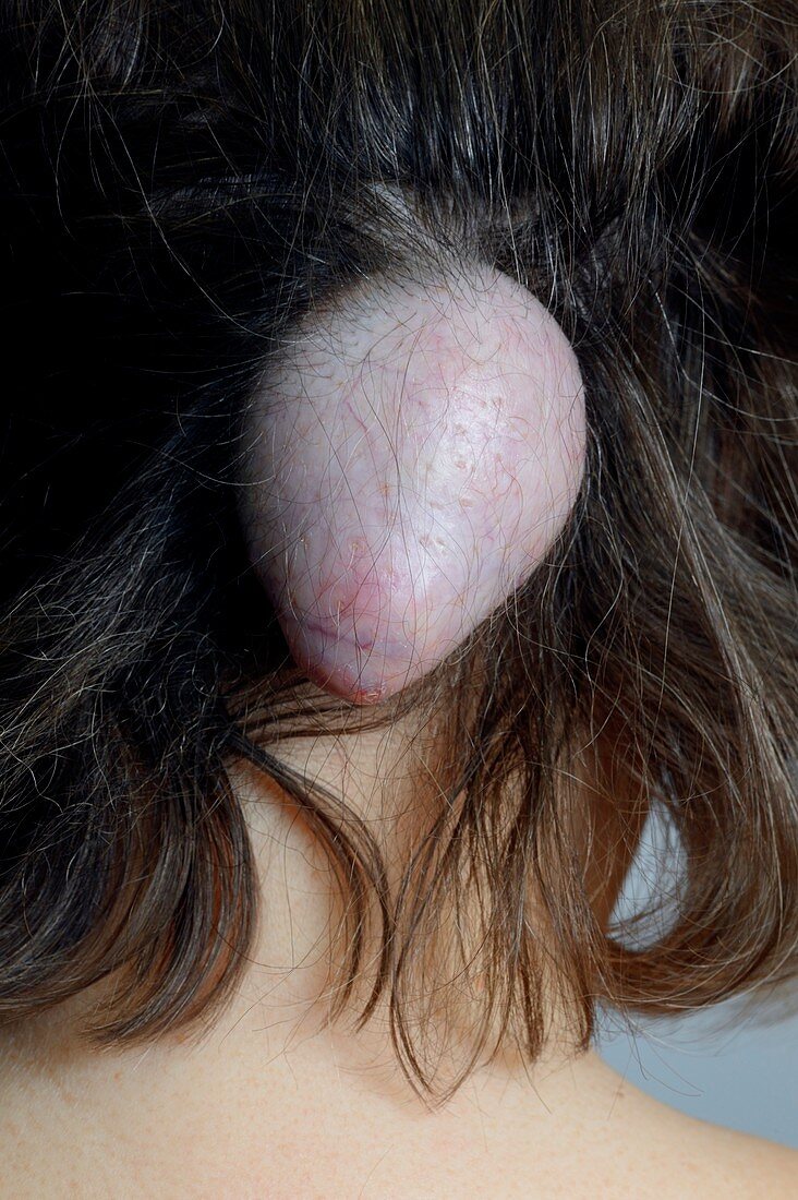 Sebaceous cyst on the scalp