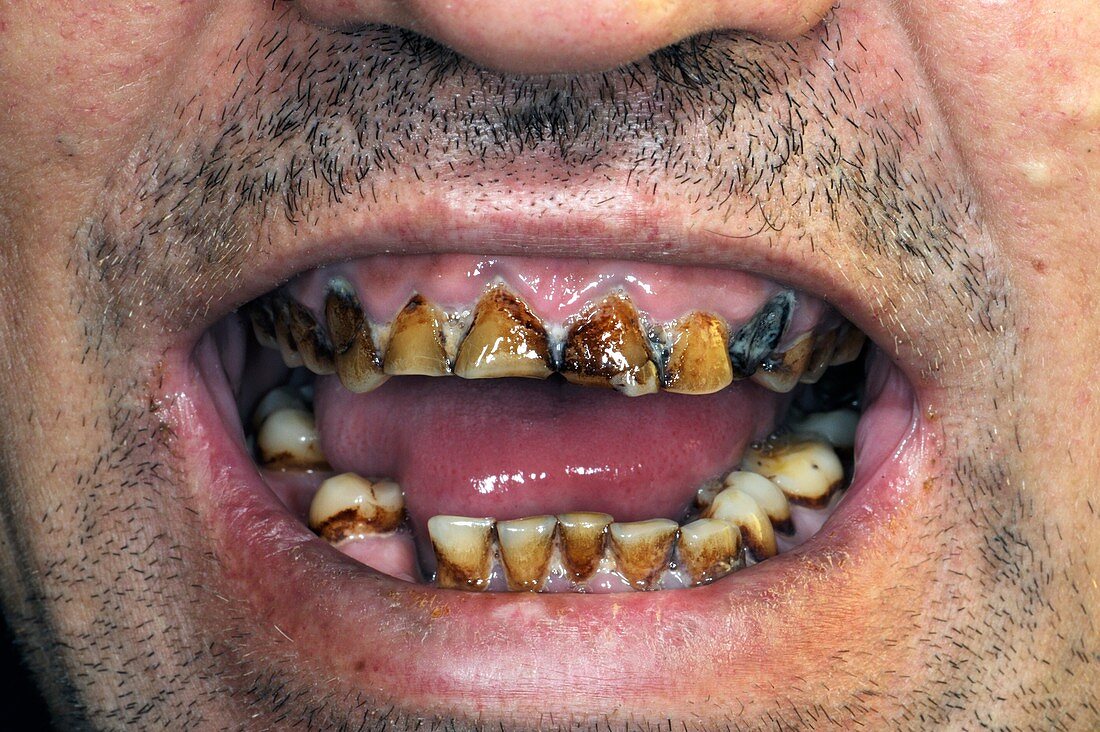Nicotine stained and decayed teeth