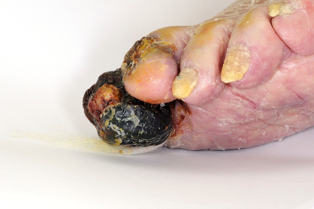 Gangrene of the toes