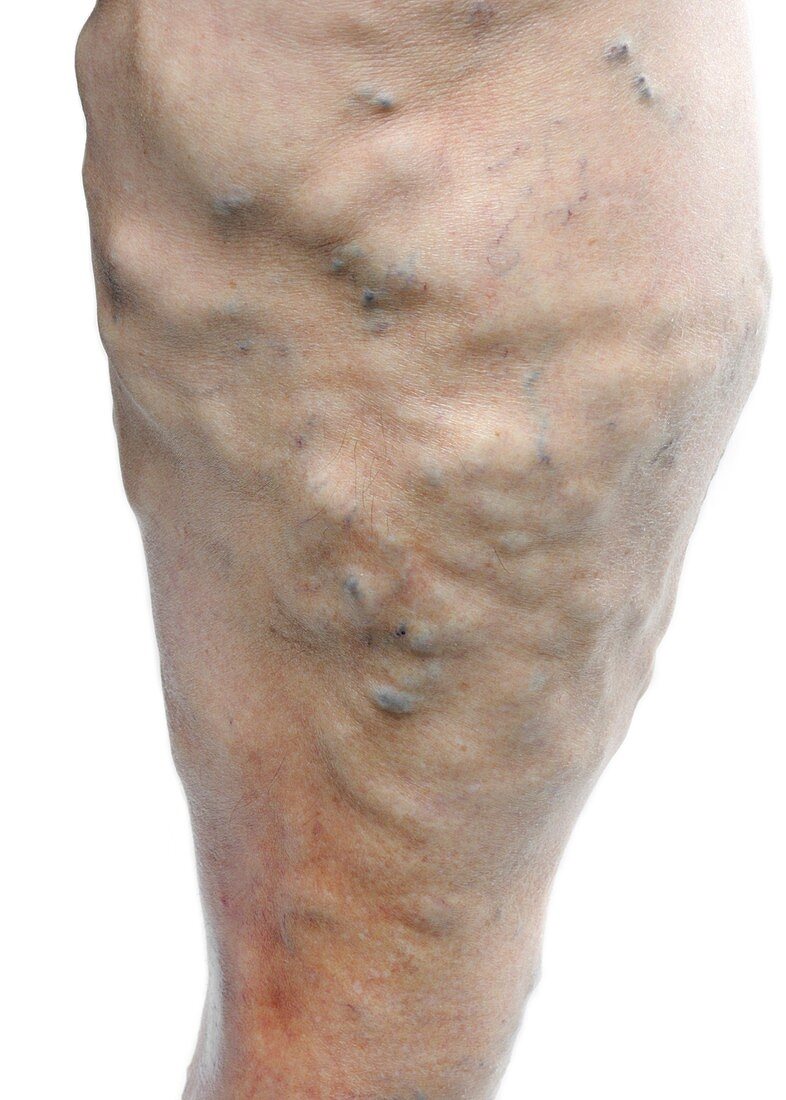 Varicose veins in the leg