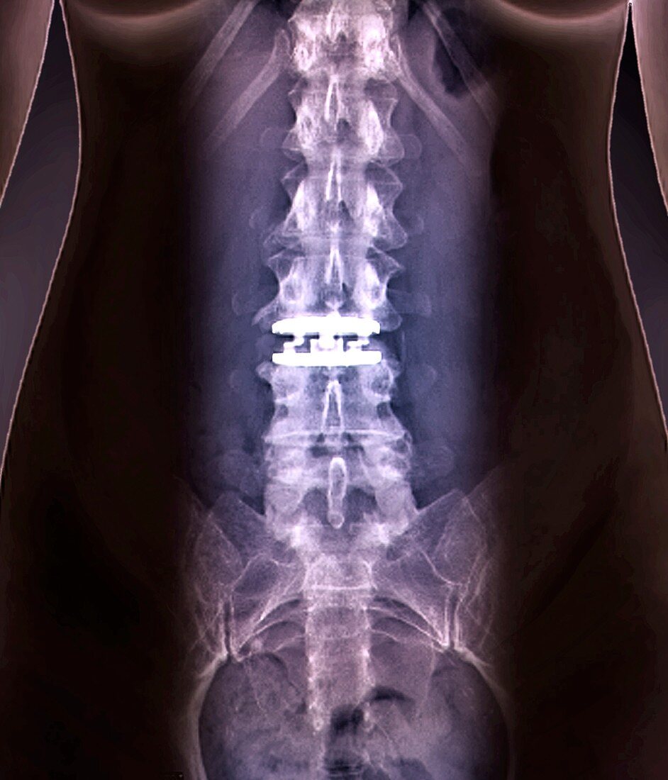 Artificial spinal disc,X-ray