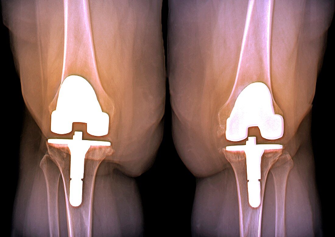 Prosthetic knees and obesity,X-ray