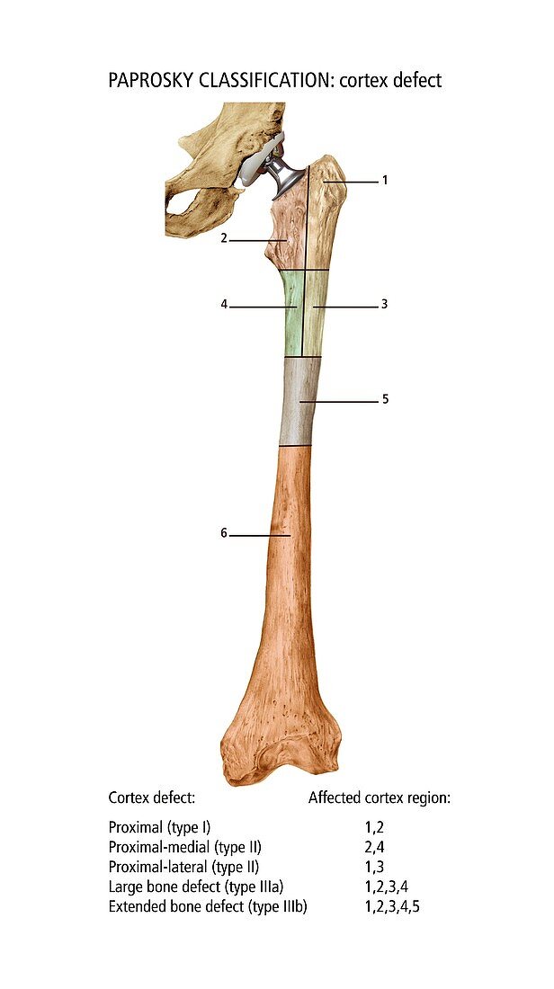 Paprosky femur defect classification