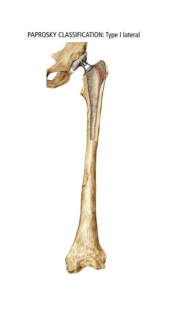 Paprosky femur defect,type I lateral